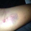 Crazy bruise on my arm from having a rolling vein when they tried to put the IV in my arm, ended up having to go in my hand.