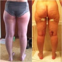 This was how i looked The first week after The lipo, and The before picture I took at home.