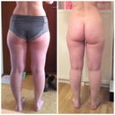 This was about , hmm maybe one month after My lipo, you Can see a little change...