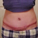 @ 3wk,First look at scar...still have swelling but not so bad as expected