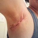 Rt Arm... doesn't look pretty and doesn't feel so great either!