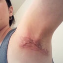 Lft Arm..irritated and hurts...hoping this will soon calm down.