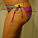 You can still see my bandages from surgery and my drain!