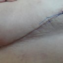 Left sutures, 15 days post-op.