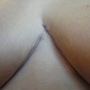 Middle sutures, 15 days post-op.