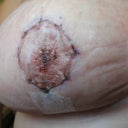 Other one, 15 days post-op.