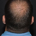 Hair Restoration