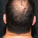 Hair Restoration