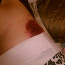 hey look--a person is in those bruises! Day 2 bruises from lipo--or where people kicked me while I was knocked out.
