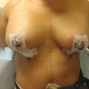 Boobs Day 1 Post Op