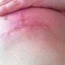 right side incision underneath breast