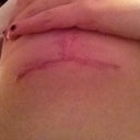left incision underneath