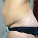 Here is a side view before surgrey!