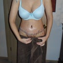 Front view one week post op