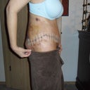 Side view one week post op