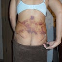 Back view one week post op