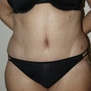 2 weeks post-op