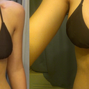 Before vs Day 14 - yessss :)