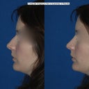 Before/after - computer imaging from a consultation.