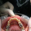 before invisalign