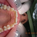 before invisalign