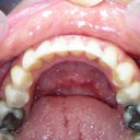 after invisalign