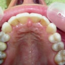 after invisalign