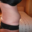 Day 59 8 wk 2 days - bulging, now named my rubber ring look.......looking at my right side