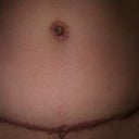 1st tt 6 month postop