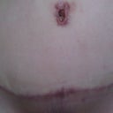 revision 3 month postop