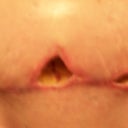 After debridement...ouch!
