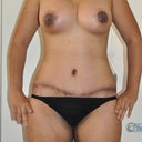 7.5 wks post op.  Breasts have dropped about 4 wks.  There's still some swelling on mid abdomen.