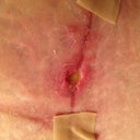 This is what my PS said was a spitting stitch. It was puffier and had a scab. My husband says it looks better than it did.