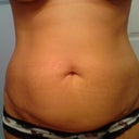 1 day pre op
