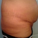 my BUTT is the left side.. gross! 1 day pre op
