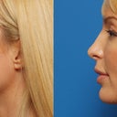 Side profile Doc simulation, I like how he has maintained stronger proportions to match my chin and forehead, this picture also shows subtle jaw sculpting