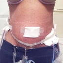 10 days post op.