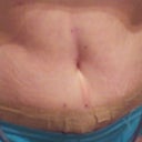 Look at the strange old scar that appeared under my belly button.  Do you think it's left-over from my hernia or a stretch mark that I don't recognize?