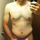 7 days post-op. Swelling started.