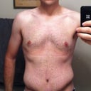 18 days post-op. Swell hell.