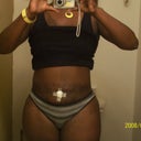 Front View 7 Wk Post Op. The cotton Ball is to prevent any leakage from my belly button