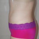 3 weeks. not much change. still have a seroma below my belly button and some general swelling. not too bad though