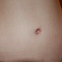 3 weeks. BB. fades more everyday, and the scar started to pull back into the stem. starting to look like a normal BB. when all redness is gone, it will look completely natural.