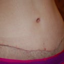 3 weeks. close up of scar. you can see how the incision is higher on the left - that is where my seroma is. also, notice the red dot right above the incision in the middle? i have a few of those. that is where a little knot of suture is outside of my skin. not exactly sure what to do with those places. will ask my PS next week.