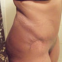6 week scar - left side