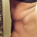 6 week scar - right side
