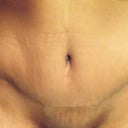 6 week scar - front (It really doesn't bother me, but looking at this pic it looks like I have what others call a dog ear on the left side???