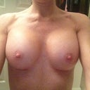 20 days post op, still need to drop but the girls are getting softer. One look bigger in the pic but is because of the way the pic was taken and I was holding the camera. They are both same size and I LOVE THEM!!!