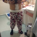 One day post op still not standing straight
