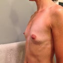 Pre-op